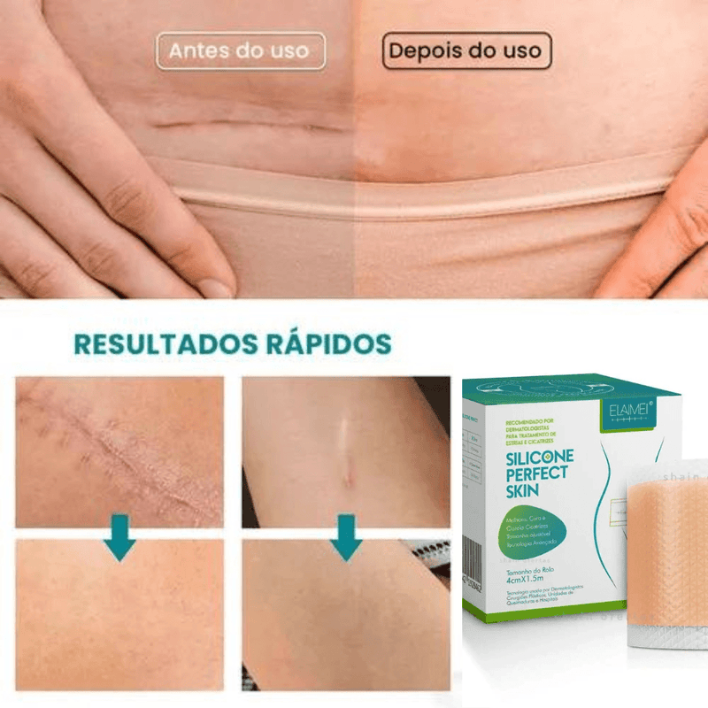 Cicatri Skin™ Fita Removedora De Cicatrizes- últimas unidades 50% OFF